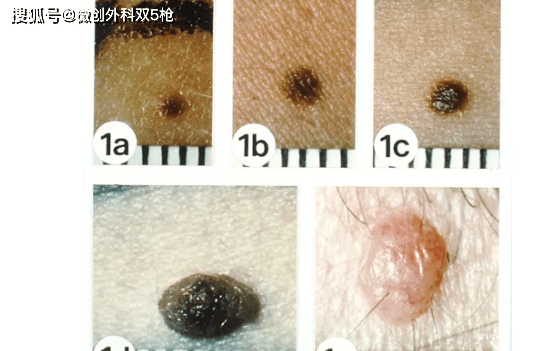 hth华体官方下载app|
身上黑痔小心要了命！掌握ABCDE原则 教你肉眼判断玄色素瘤(图5)